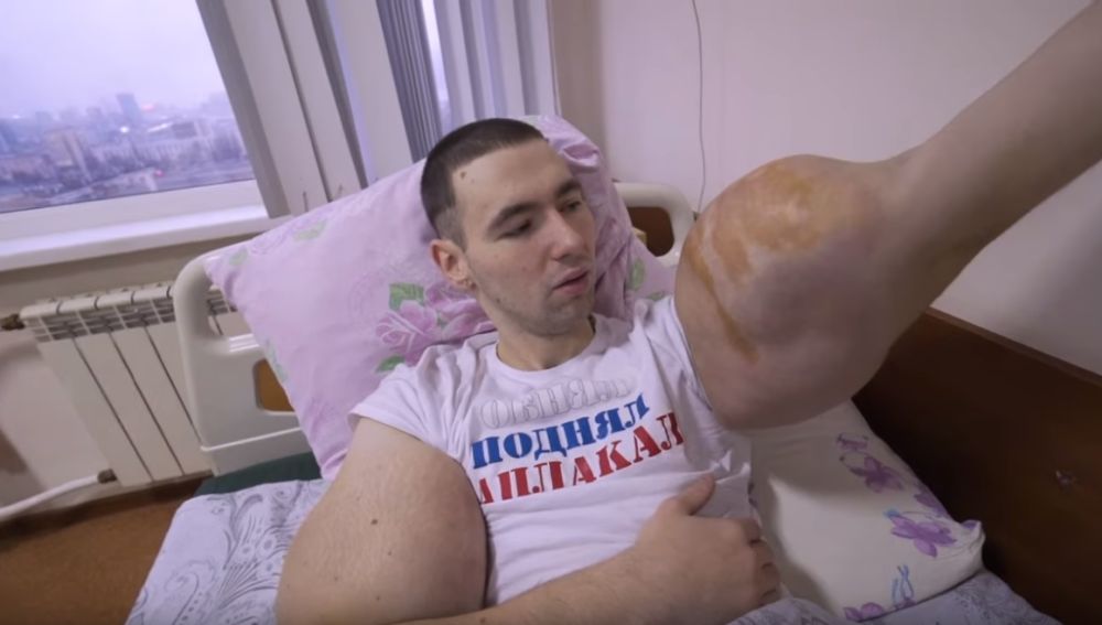El 'Popeye ruso', obligado a operarse de sus bíceps para salvar su vida
