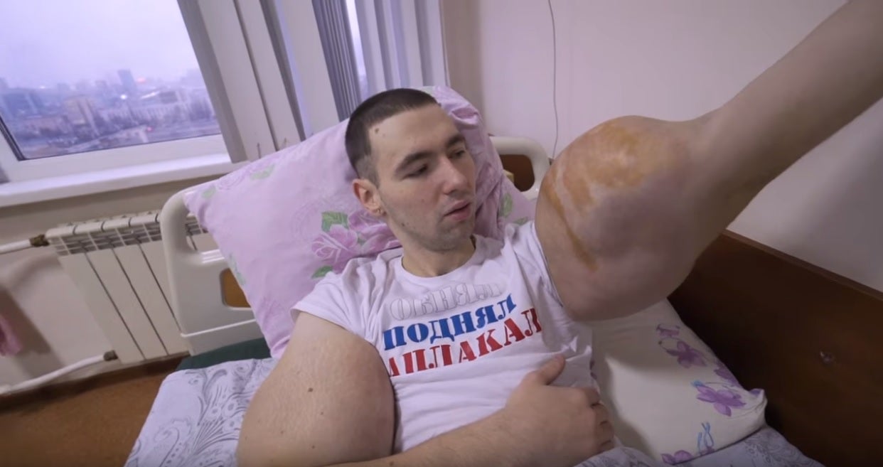 Duras imágenes: Sale a la luz el vídeo de la operación del 'Popeye ruso' en los bíceps para salvar su vida Duras imágenes: Sale a la luz el vídeo de la operación del 'Popeye ruso' en los bíceps para salvar su vida