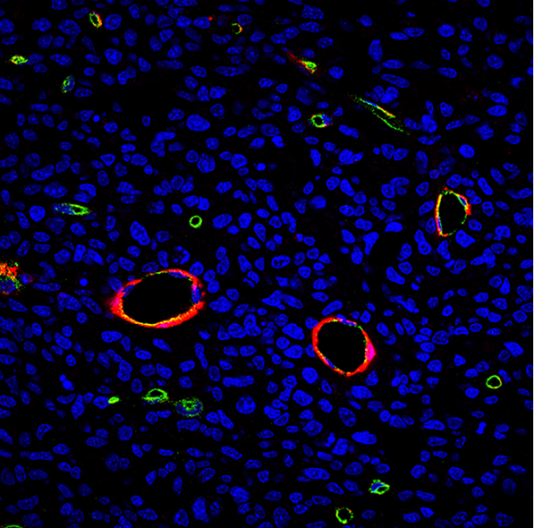 Extirpan un tumor de 30 kilos causado por una enfermedad genética Extirpan un tumor de 30 kilos causado por una enfermedad genética
