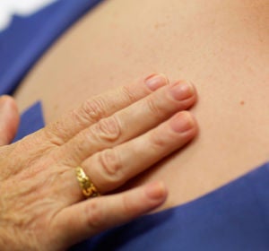 Cáncer de piel, melanoma Cáncer de piel, melanoma