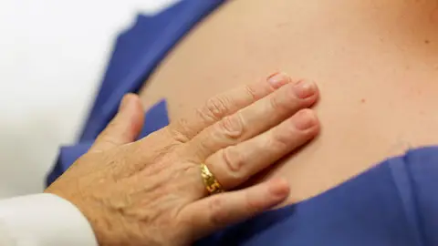 Cáncer de piel, melanoma Cáncer de piel, melanoma