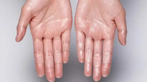 ¿Por qué sudan las manos? ¿Por qué sudan las manos?