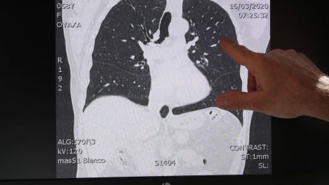 Pulmones afectados COVID-19