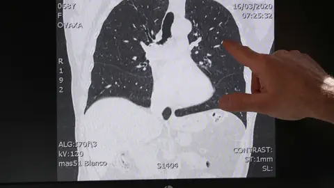 Pulmones afectados COVID-19 Pulmones afectados COVID-19