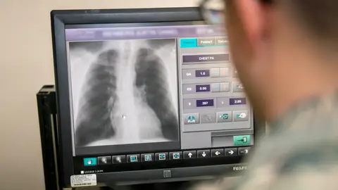 Radiografias de torax para detectar la COVID 19 Radiografias de torax para detectar la COVID 19