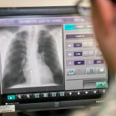 Radiografias de torax para detectar la COVID 19