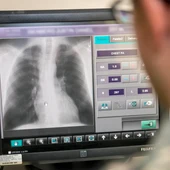 Radiografias de torax para detectar la COVID 19 Radiografias de torax para detectar la COVID 19