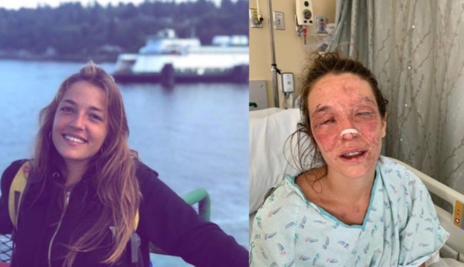 La historia de Marta, una joven que sufrió un accidente con sosa caustica: "Confío en ver el mar y leer un libro" La historia de Marta, una joven que sufrió un accidente con sosa caustica: "Confío en ver el mar y leer un libro"