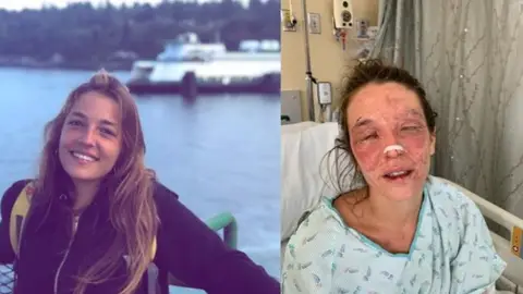 Imagen de Marta antes y después del accidente con sosa cáustica Imagen de Marta antes y después del accidente con sosa cáustica