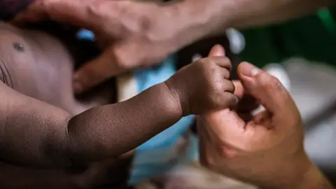 polio en África polio en África