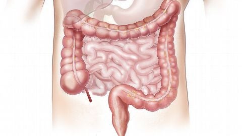 C&aacute;ncer de colon