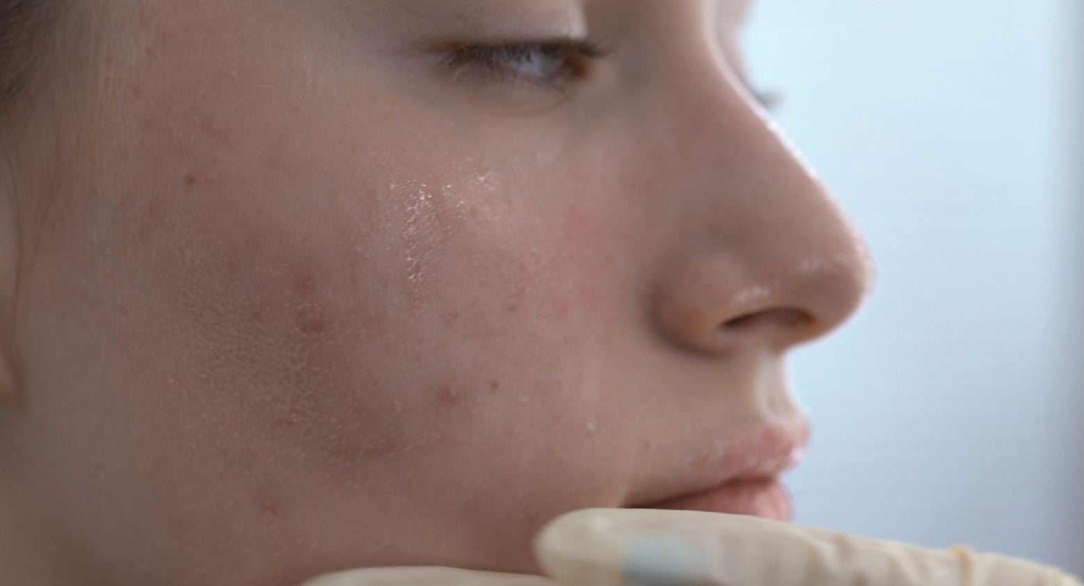 Soluciona el acné con una terapia sistémica Soluciona el acné con una terapia sistémica