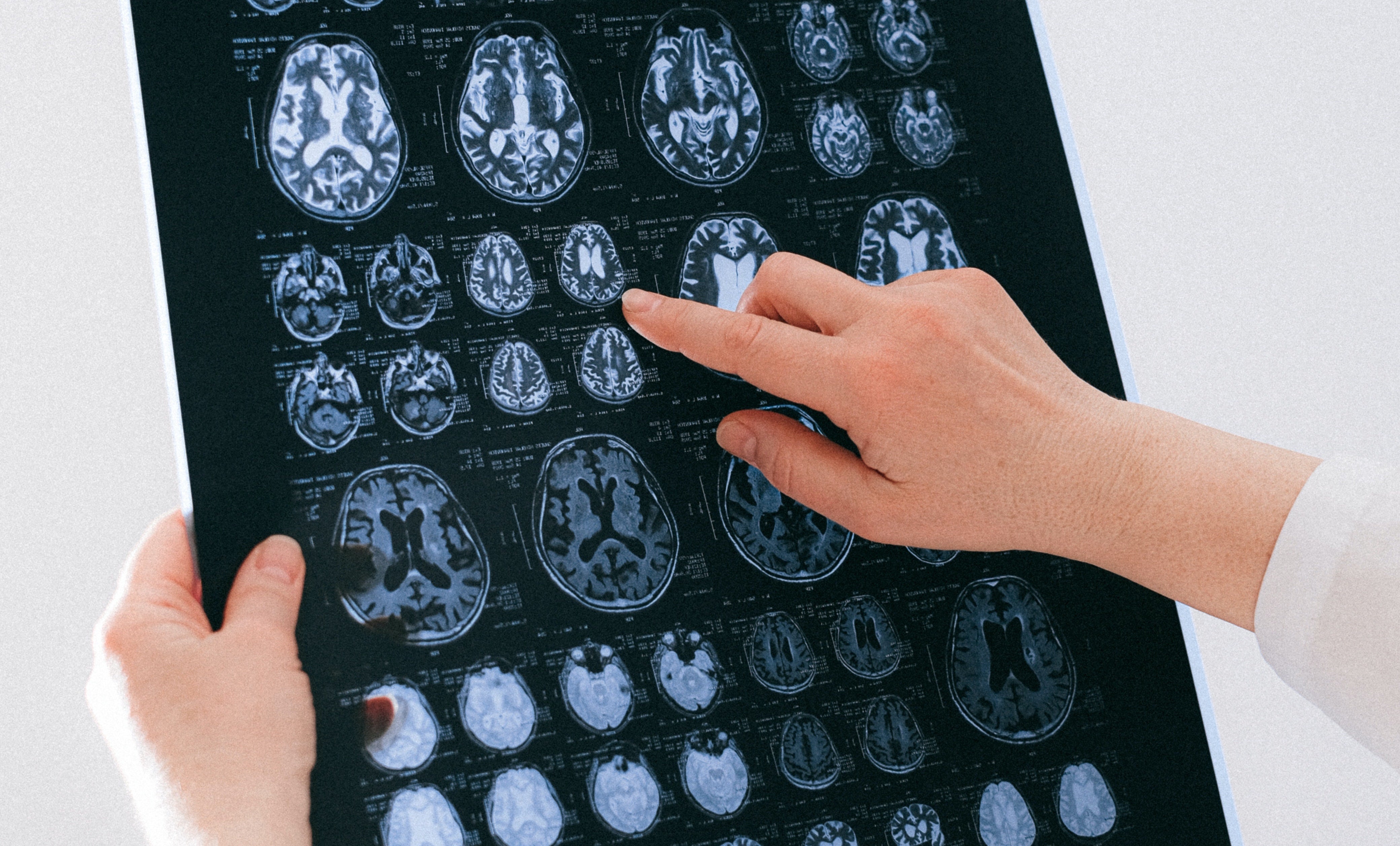 Las enfermedades neurológicas afectan al 60% de los pacientes de coronavirus ingresados Las enfermedades neurológicas afectan al 60% de los pacientes de coronavirus ingresados