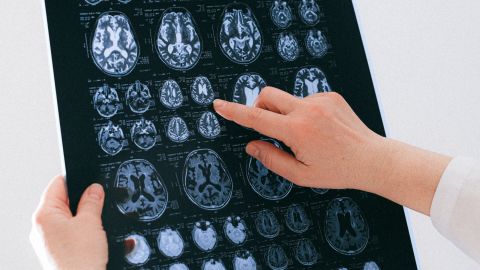 Radiograf&iacute;a cerebro