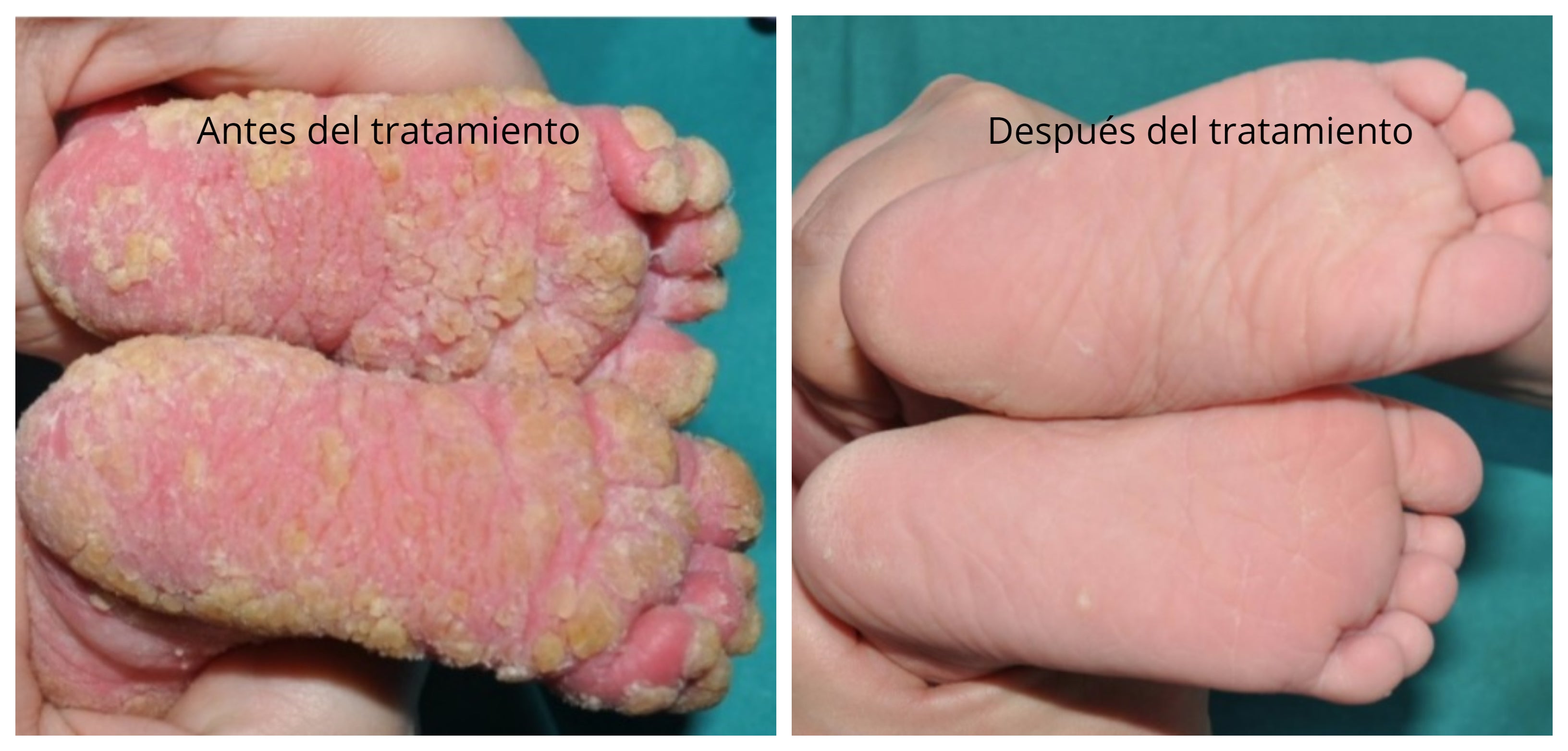 Investigadores españoles hallan el primer tratamiento del mundo para un tipo de ictiosis Investigadores españoles hallan el primer tratamiento del mundo para un tipo de ictiosis