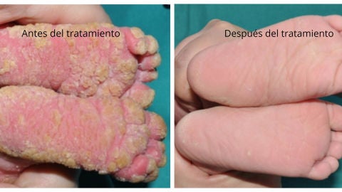 Los pies de la bebé antes y después del tratamiento contra la ictiosis