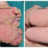 Los pies de la bebé antes y después del tratamiento contra la ictiosis