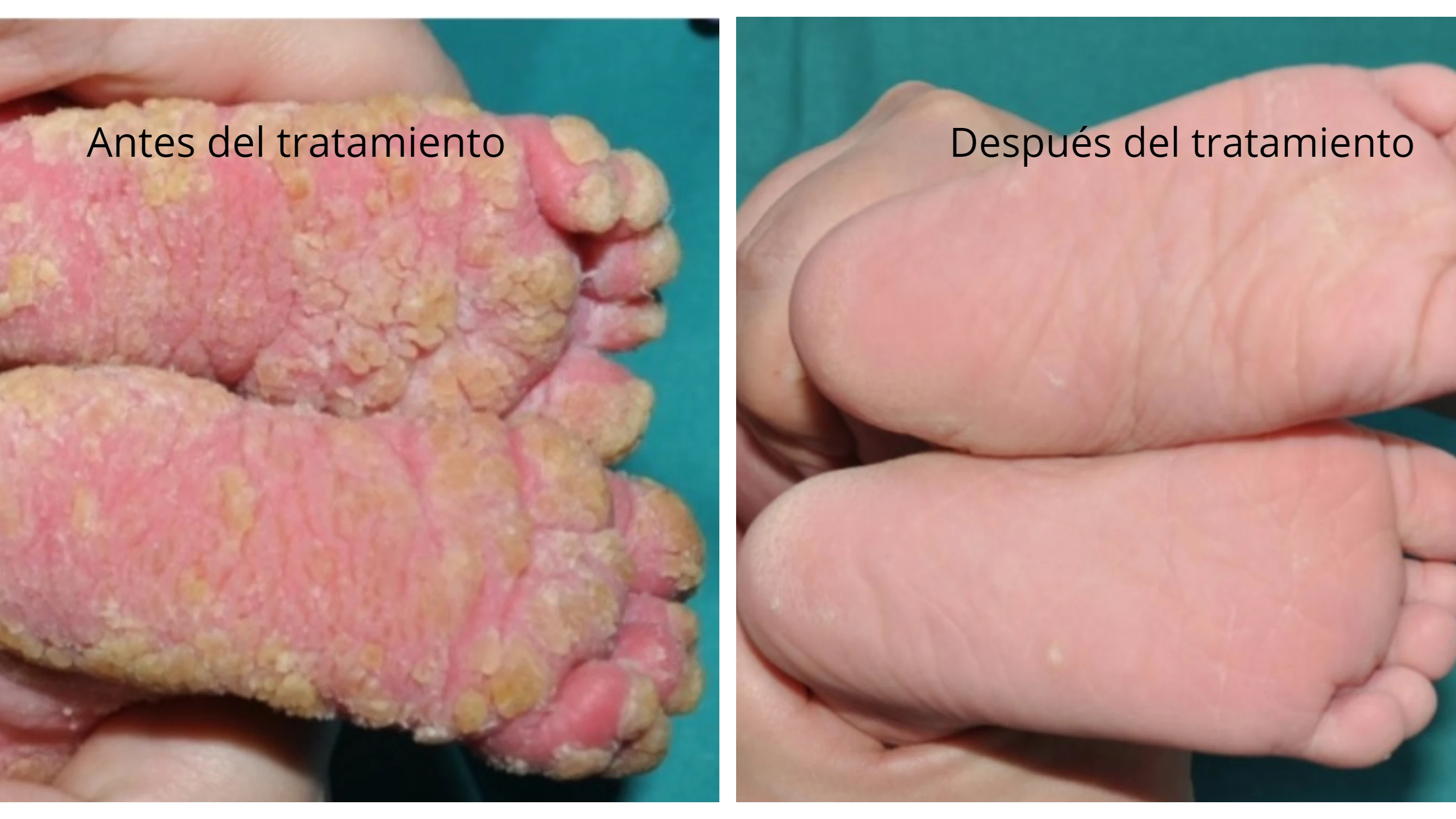 Los pies de la bebé antes y después del tratamiento contra la ictiosis Los pies de la bebé antes y después del tratamiento contra la ictiosis