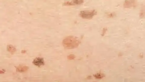 Manchas en la Piel la farmacia en casa