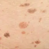 Manchas en la Piel Manchas en la Piel
