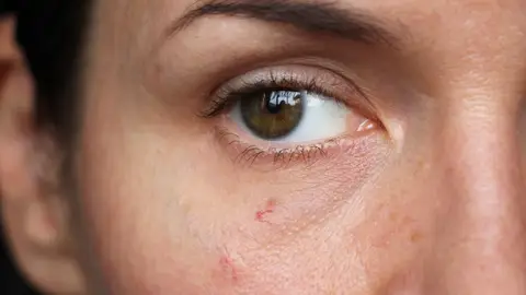 Láser Vascular Láser Vascular