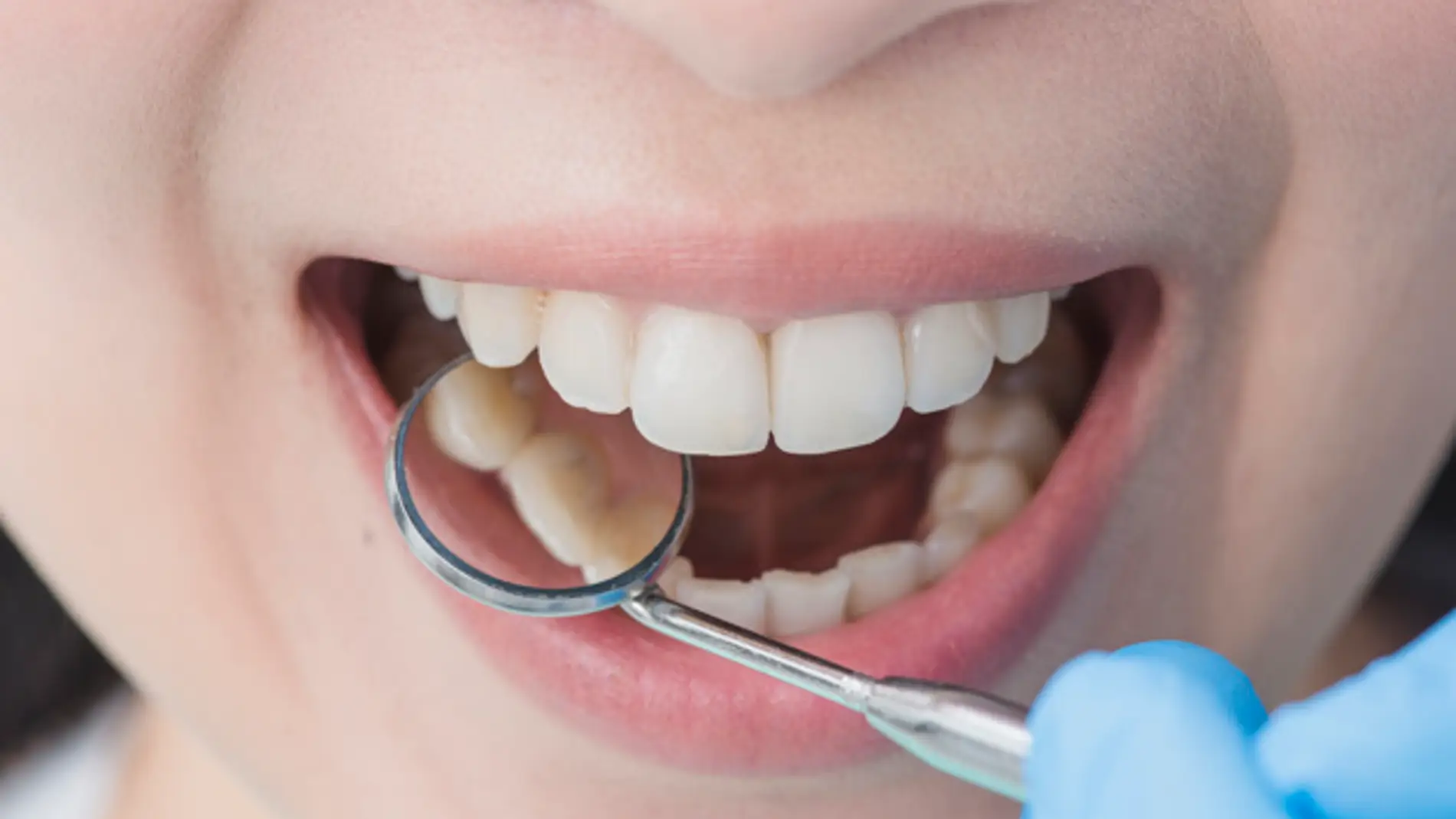 Los dentistas pueden detectar en la boca síntomas de la infección por VIH