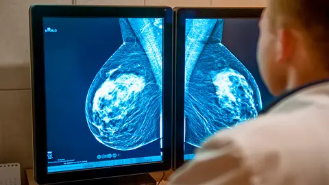 Cancer de mama Algunas mujeres con cancer de mama podran evitar la quimioterapia