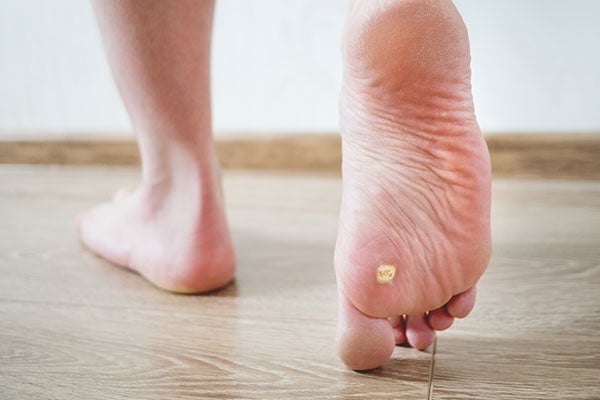 Recupera tu piel tras el verano: elimina las verrugas con tecnología láser en Centro Dermatológico Estético de Alicante Recupera tu piel tras el verano: elimina las verrugas con tecnología láser en Centro Dermatológico Estético de Alicante