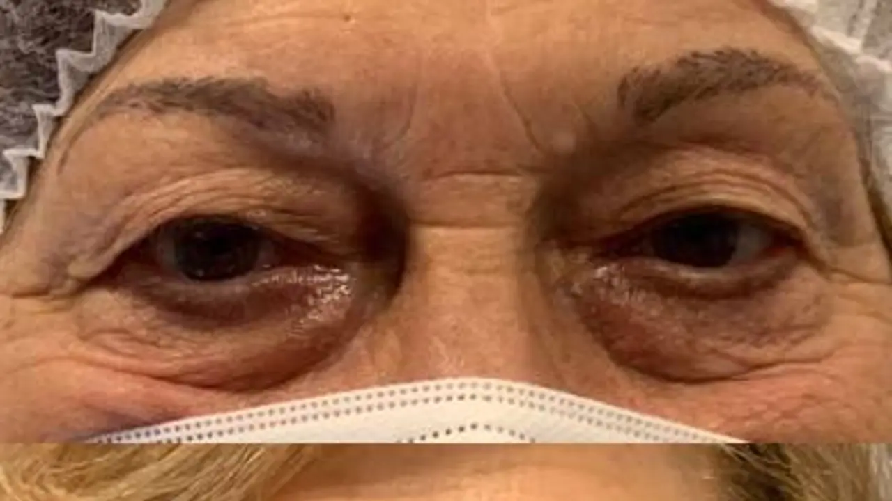 Quirónsalud Málaga incorpora un láser oftalmológico para blefaroplastia sin cirugía