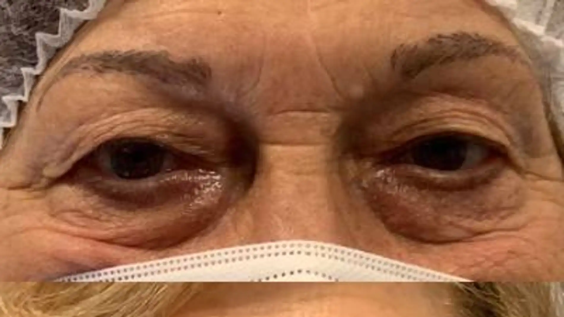 Quirónsalud Málaga incorpora un láser oftalmológico para blefaroplastia sin cirugía