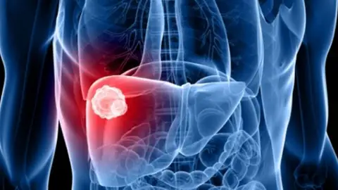 El objetivo de esta fecha es impulsar a nivel mundial todas las iniciativas y estrategias que pueda realizar el sector salud hepatitis