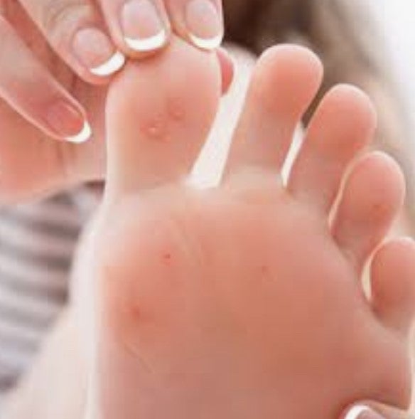 Centro Dermatológico Estético elimina con láser las molestas verrugas plantares tan frecuentes en verano Centro Dermatológico Estético elimina con láser las molestas verrugas plantares tan frecuentes en verano