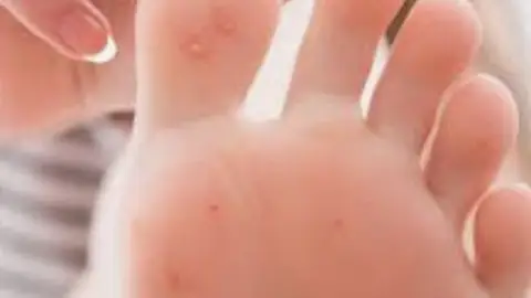 Berruga plantar Berruga plantar