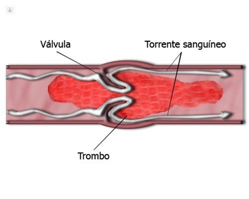 Trombos y trombosis Trombos y trombosis