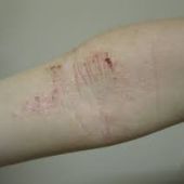 La Dermatitis Atópica es la segunda causa más frecuente de visita al dermatólogo