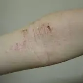 La Dermatitis Atópica es la segunda causa más frecuente de visita al dermatólogo La Dermatitis Atópica es la segunda causa más frecuente de visita al dermatólogo