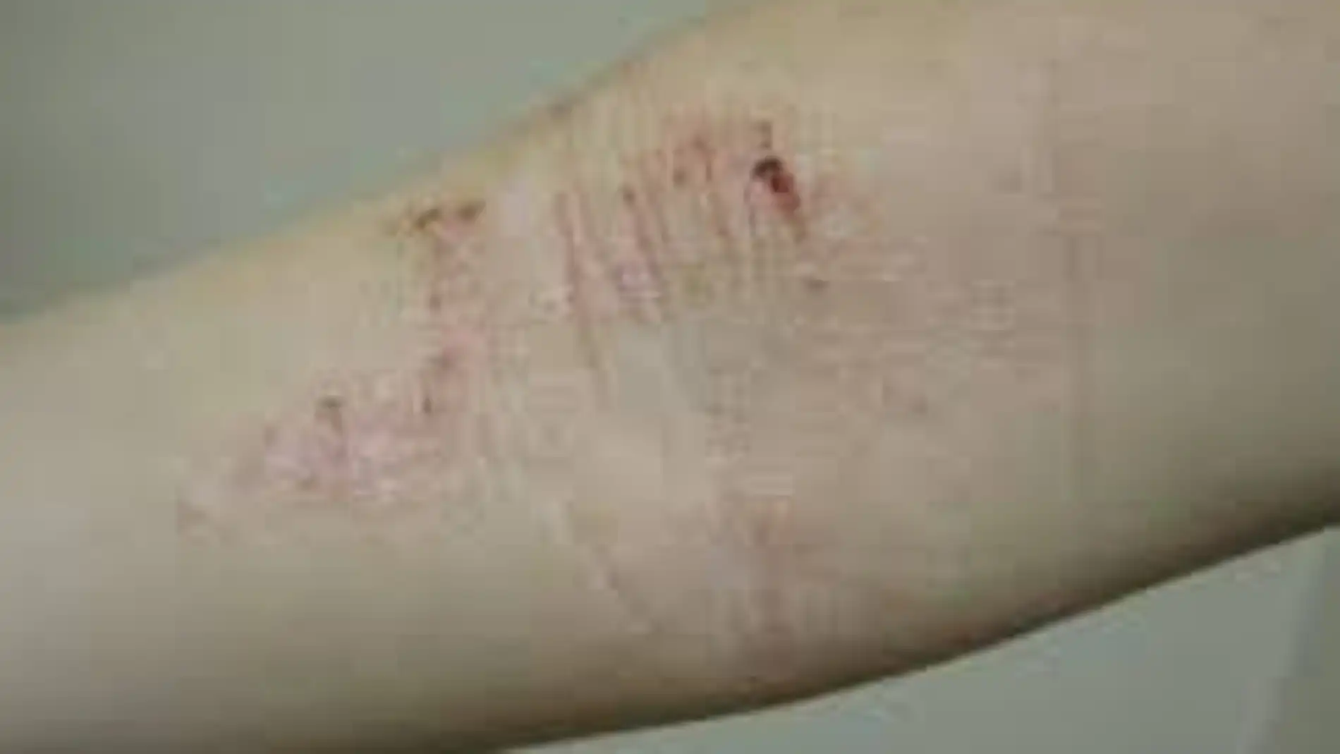 La Dermatitis Atópica es la segunda causa más frecuente de visita al dermatólogo