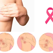 cáncer mama cáncer mama