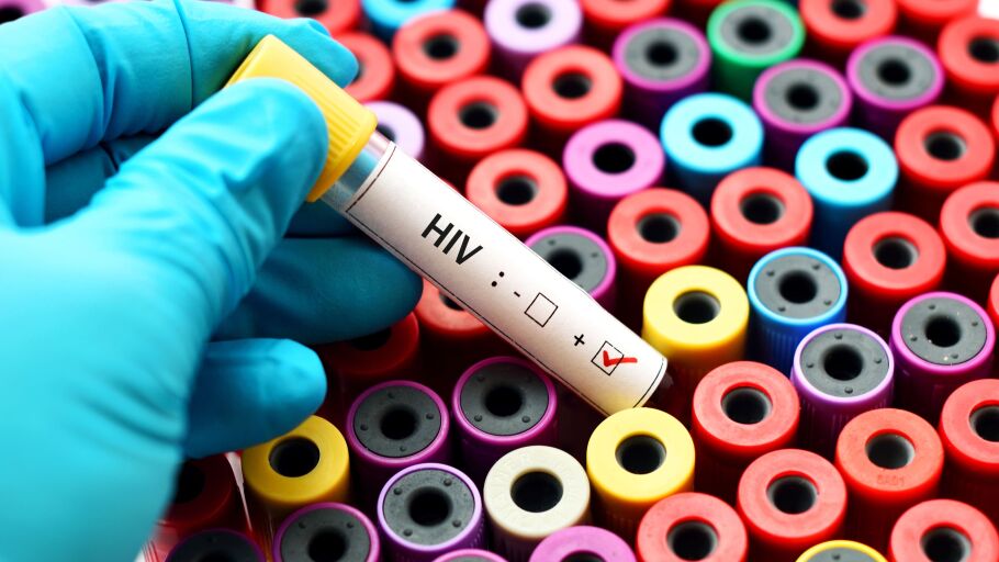 An&aacute;lisis de sangre con resultado VIH positivo