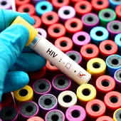 Análisis de sangre con resultado VIH positivo Análisis de sangre con resultado VIH positivo