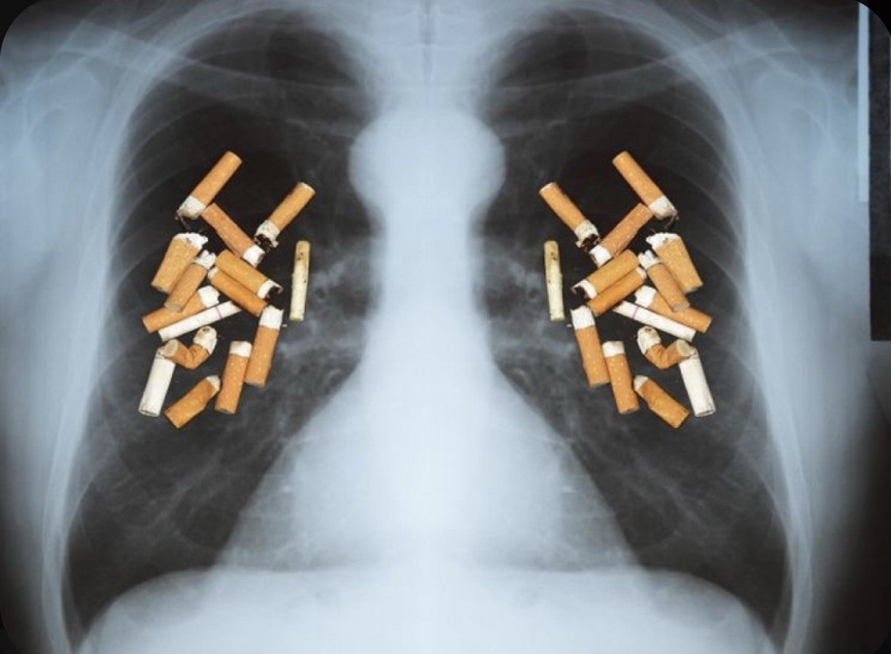 El cáncer de pulmón se incrementa en Alicante entre los jóvenes y sobre todo en mujeres a causa del consumo de tabaco El cáncer de pulmón se incrementa en Alicante entre los jóvenes y sobre todo en mujeres a causa del consumo de tabaco