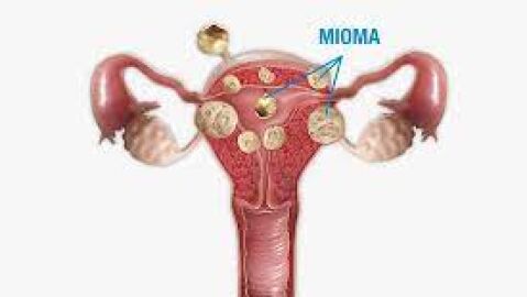 Miomas uterinos 