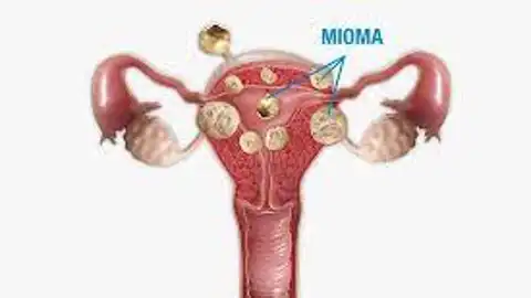 Miomas uterinos Miomas uterinos