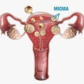 Miomas uterinos 