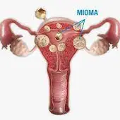 Miomas uterinos Miomas uterinos