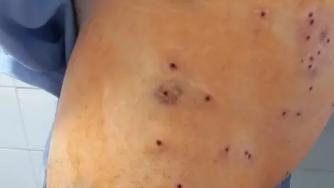 Impactos de perdigones en la pierna del ciclista Impactos de perdigones en la pierna del ciclista