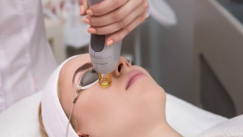 L&aacute;ser manchas