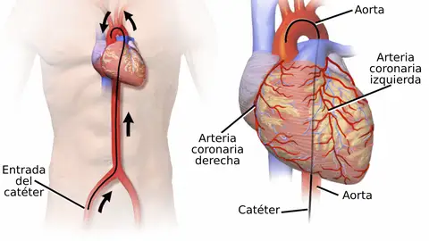 Más de 100.000 cateterismos en el Hospital Reina Sofía Más de 100.000 cateterismos en el Hospital Reina Sofía