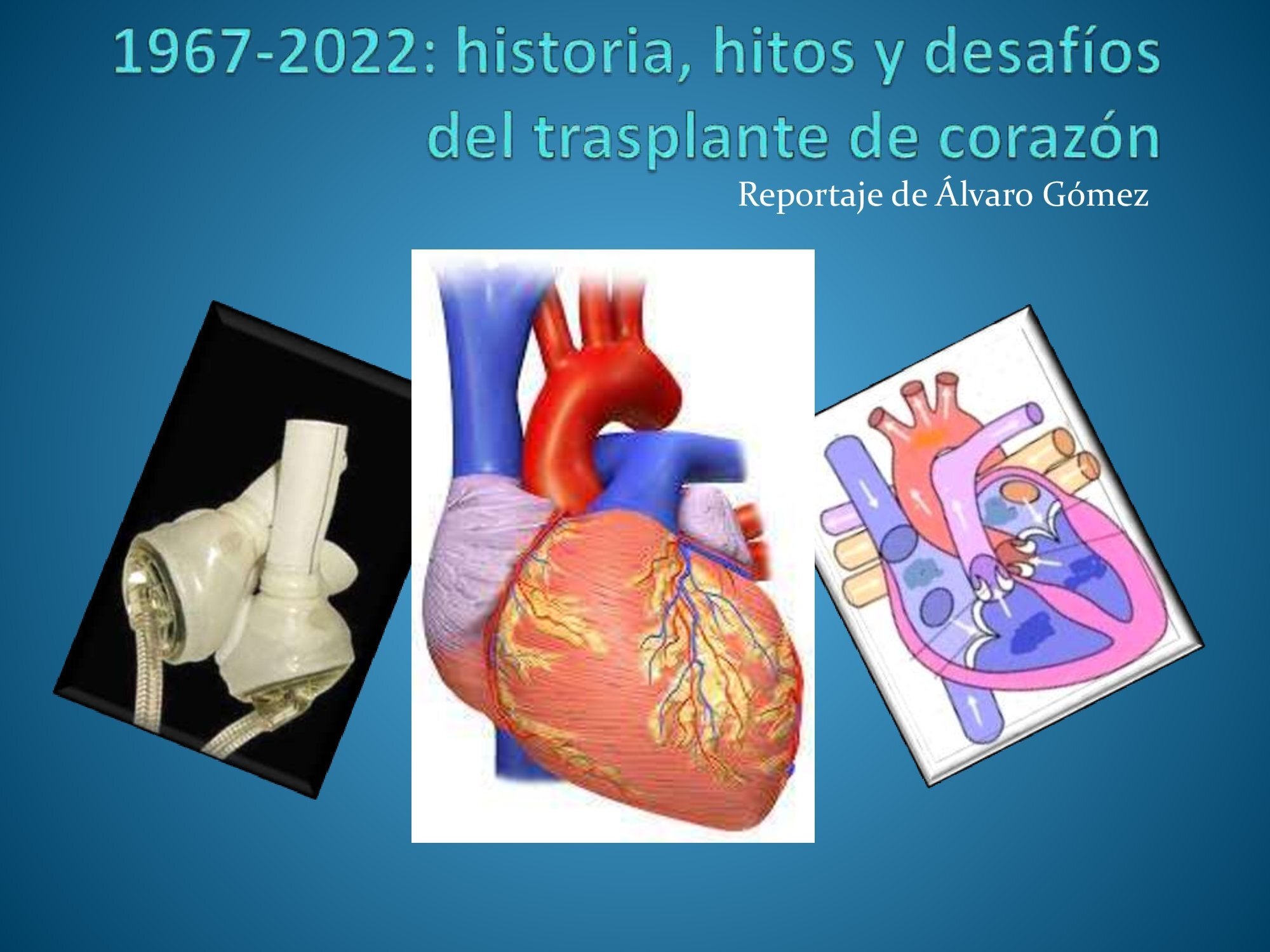 1967-2022 Historia, hitos y retos del trasplante de corazón 1967-2022 Historia, hitos y retos del trasplante de corazón