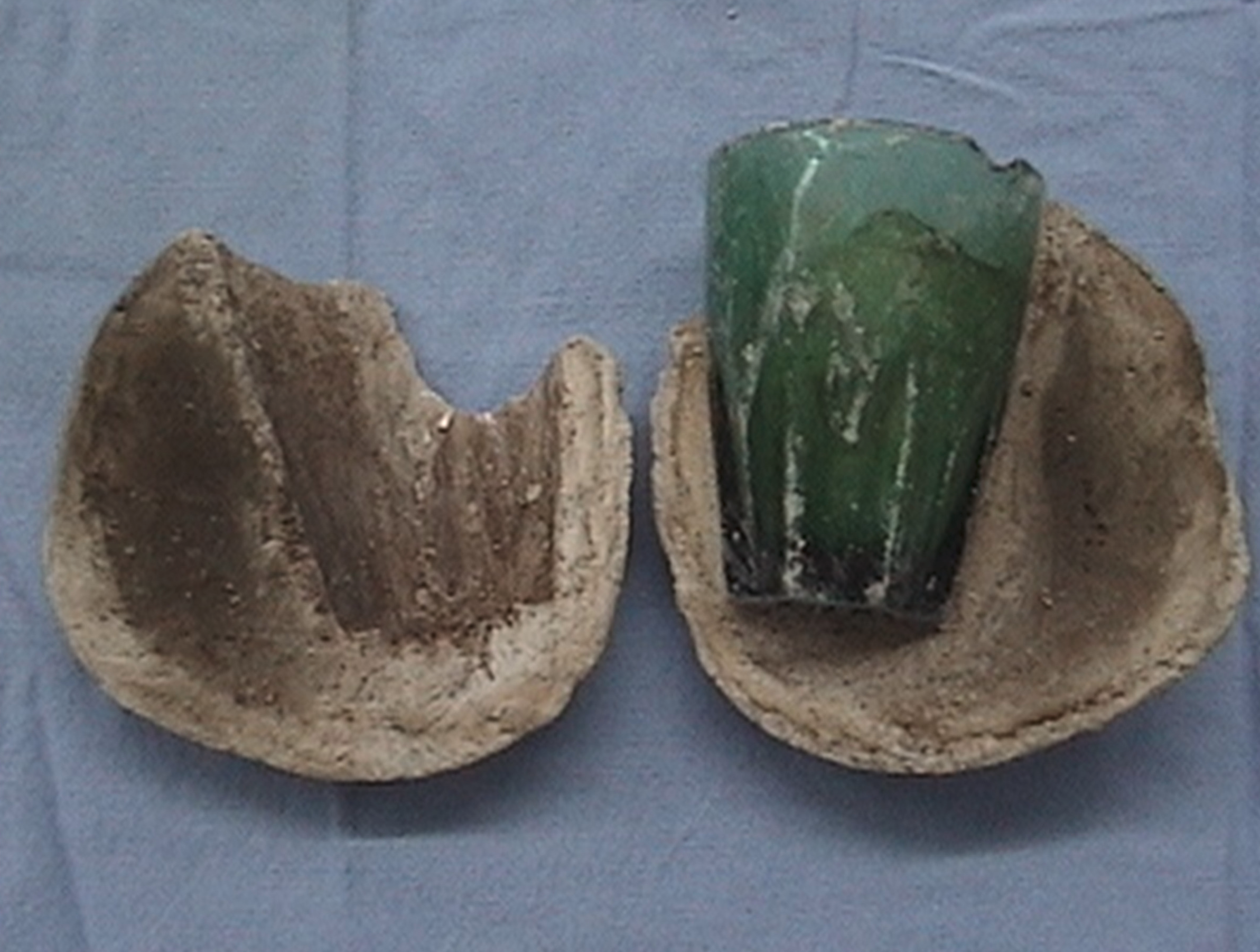 Los médicos extraen un vaso de la vejiga de una mujer que se introdujo como juguete sexual Los médicos extraen un vaso de la vejiga de una mujer que se introdujo como juguete sexual